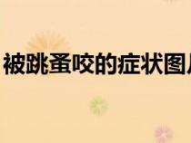 被跳蚤咬的癥狀圖片 虱子（被跳蚤咬的癥狀）