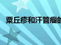 粟丘疹和汗管瘤的區(qū)別（粟丘疹和汗管瘤）
