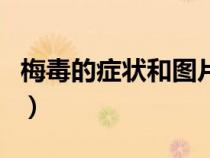 梅毒的癥狀和圖片男（梅毒的早期癥狀圖片男）