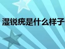 濕銳疣是什么樣子的圖片（尖銳濕疣是什么）