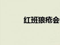紅班狼瘡會遺傳嗎（紅班狼瘡）
